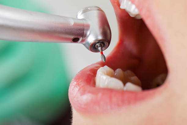 Best Emergency Wisdom Tooth Extraction in Weeping Water, NE